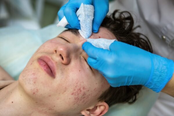 The Balance of Combination Acne Skin